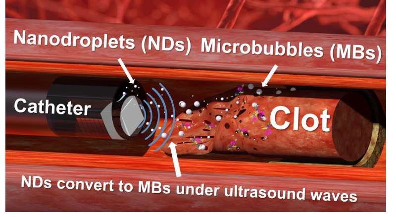 https://nfusion-tech.com/wp-content/uploads/2021/01/nanodroplets-and-ultrasound-drills-prove-effective-attackling-tough-blood-clots_5ff82b084ebbb.jpeg